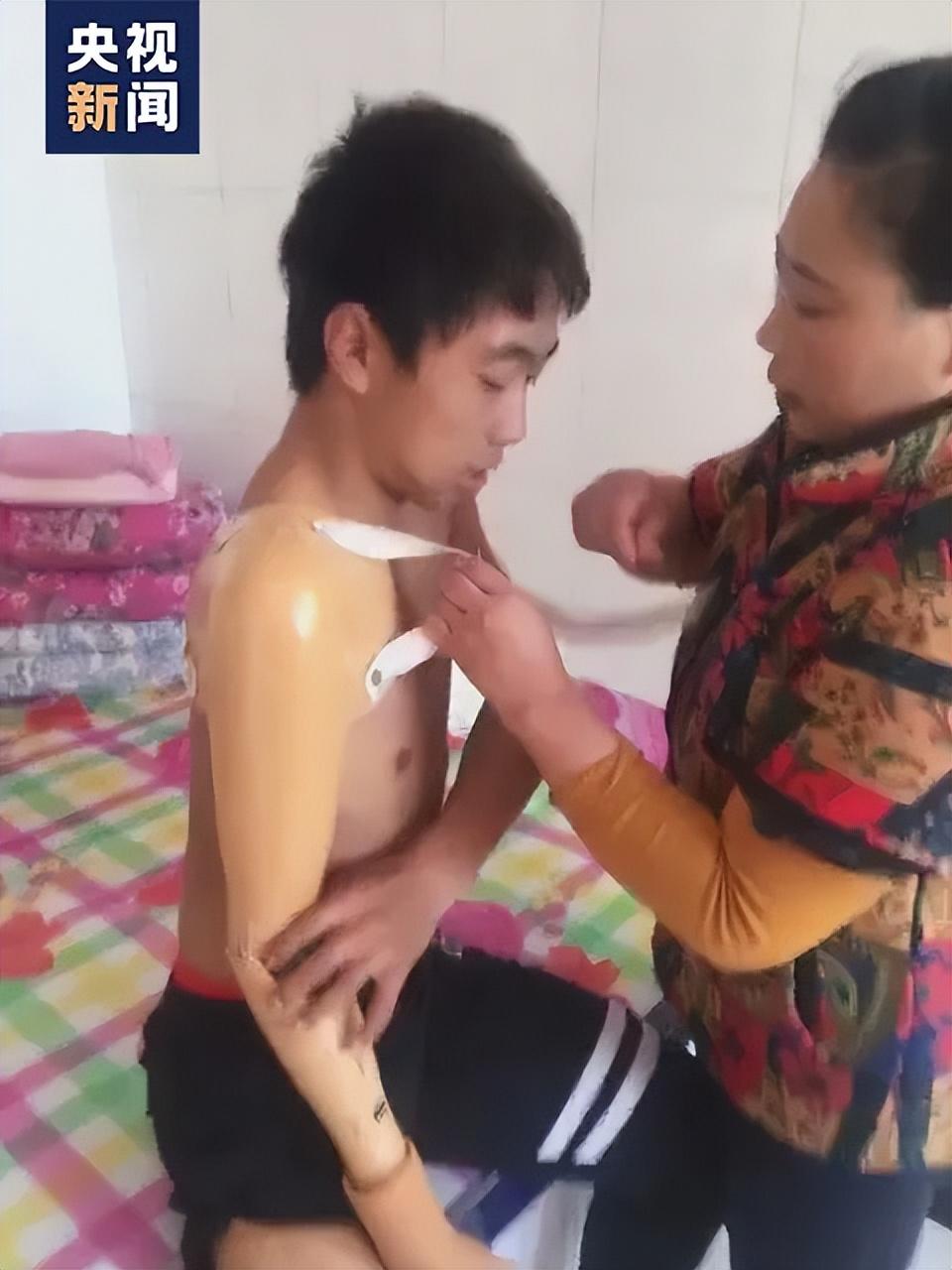 全国残疾人运动会自行车比赛_辽宁省残疾人自行车运动员_残奥会自行车运动员哪里残疾